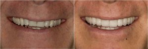 conditions that porcelain veneers can correct